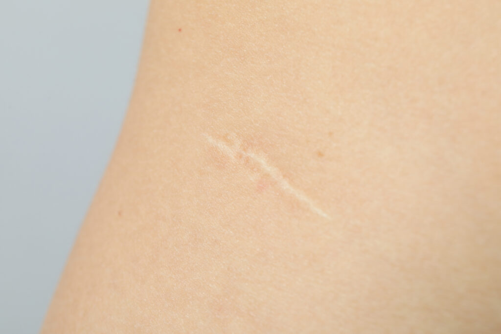 Everyone wants some Scar treatments right? Here you have few