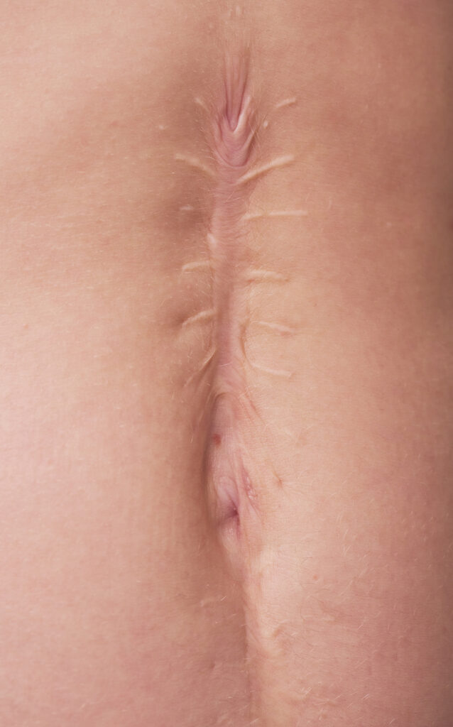 Scar treatments can help endure the trauma of wearing a scar